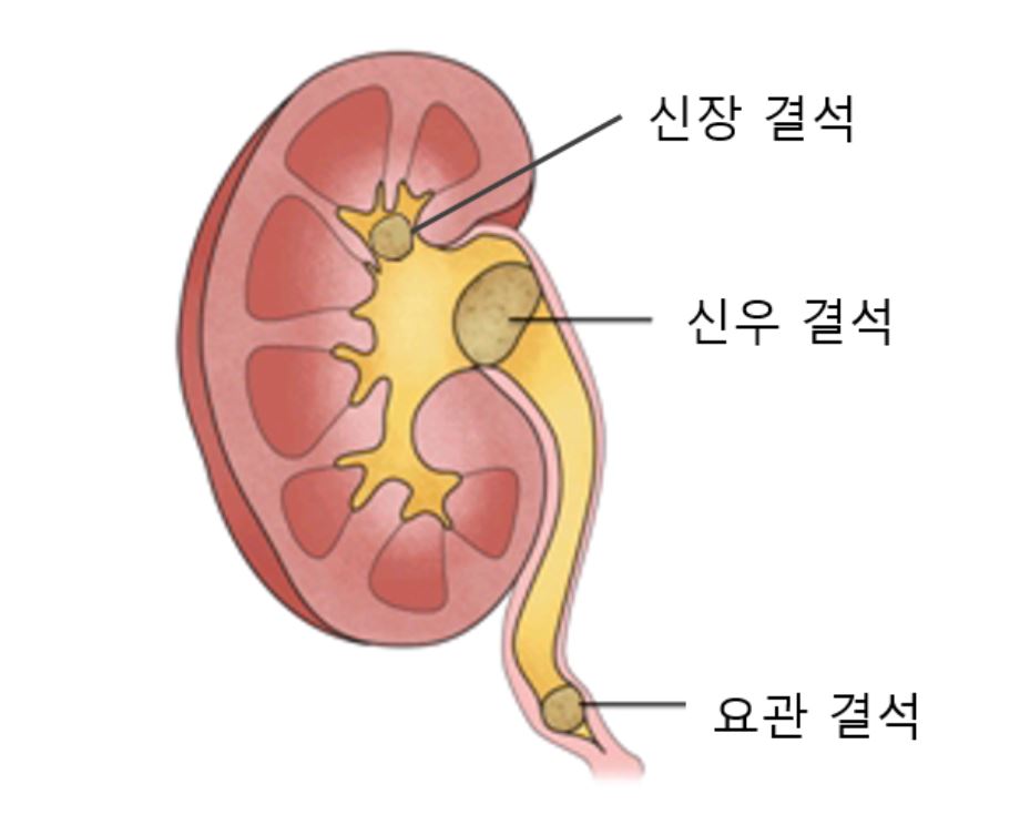 왼쪽-아랫배-통증
