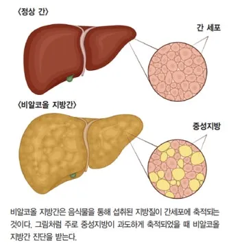 비알콜성 지방간 없애는 방법 운동 식단 중심 회복법 정리_7