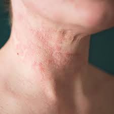 습진 가려움 집에서 응급 처치하는 방법