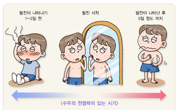 수두 예방접종시기와 전염력 있는 시기