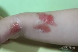 화상 물집 치료방법