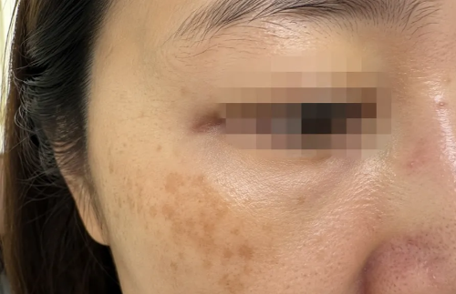 기미, 흑자, 검버섯 구분이 필요한 얼굴 피부의 갈색 반점 접사 내사진