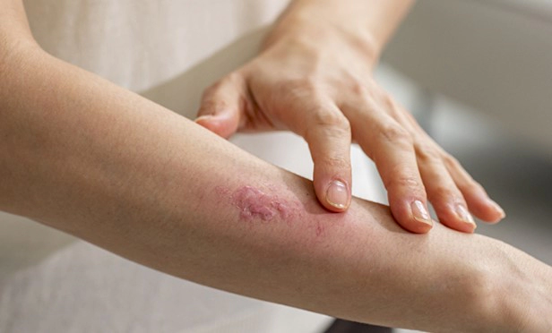 대상포진 전염성