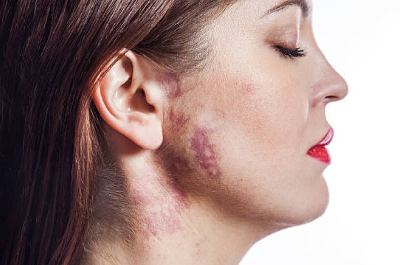 얼굴에서꼭빼야하는점 광대뼈위쪽점