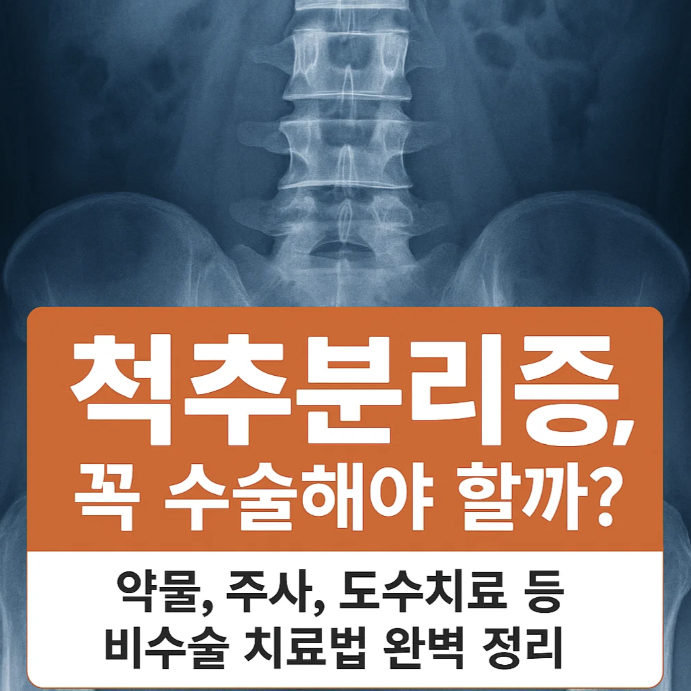 척추분리증, 꼭 수술해야 할까? 약물, 주사, 도수치료 등 비수술 치료법 완벽 정리