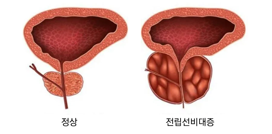정상한 전립선 상태와 전립선비대증 비교