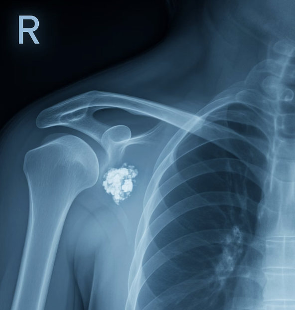 차이점 3: X-ray에 나타나는 &amp;#39;결정적 증거&amp;#39;