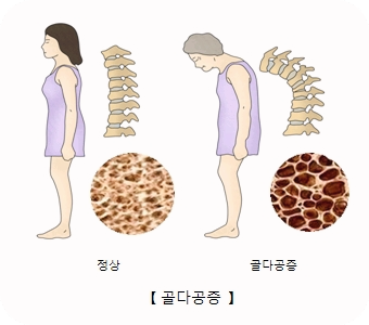 골다공증-치료방법