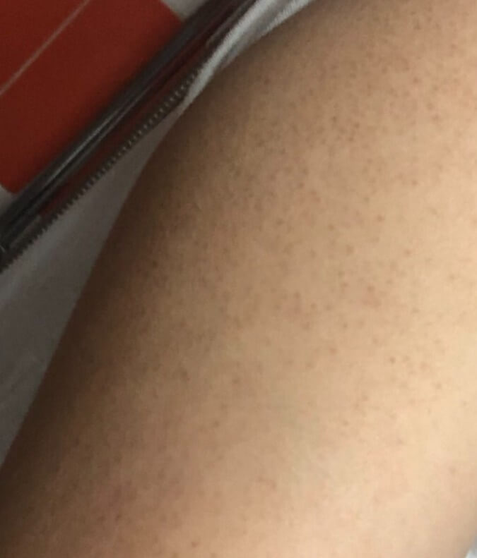 팔뚝에 생긴 모공각화증 증상