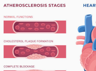 hdl 콜레스테롤 이란? 정상수치 및 높이는 방법