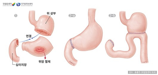 위암 원인부터 초기증상·치료·예방까지