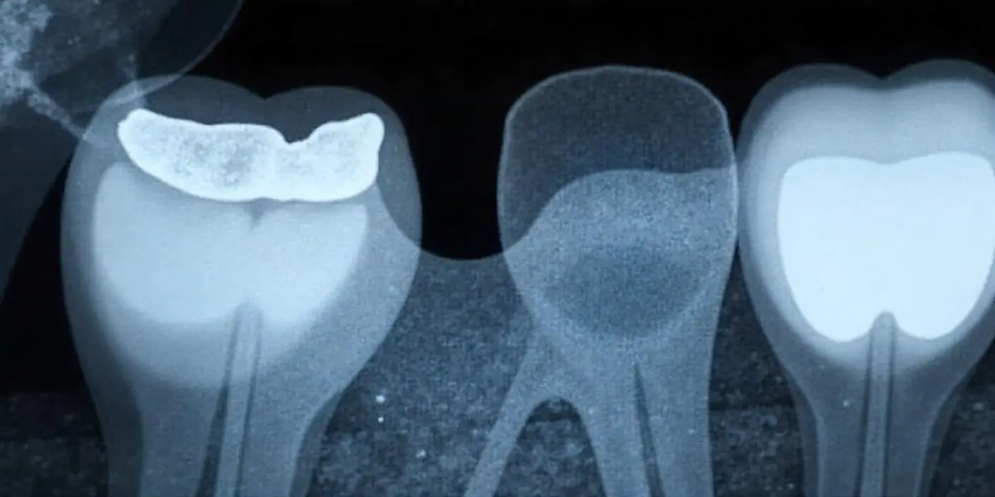 임플란트 치료 후 주의사항 안내 이미지