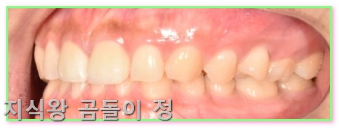 라미네이트 란? 앞니 벌어짐 해결 빠른 치료와 관리법 정리5