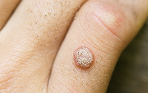 사마귀 제거방법 3