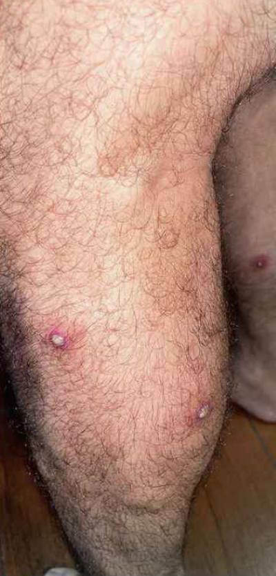 원숭이두창 증상