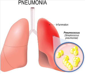 65세 이상 어르신 폐렴구균 예방접종