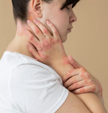 대상포진 초기증상 5