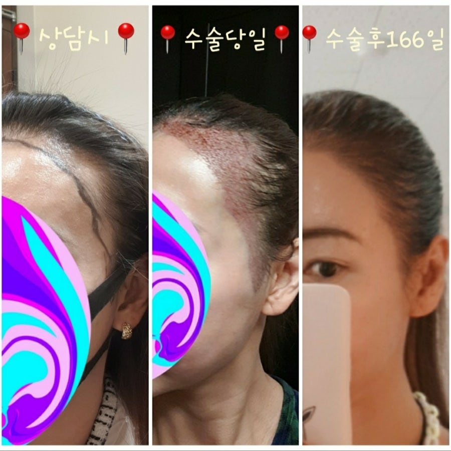 모발이식 사진 전 후 166일