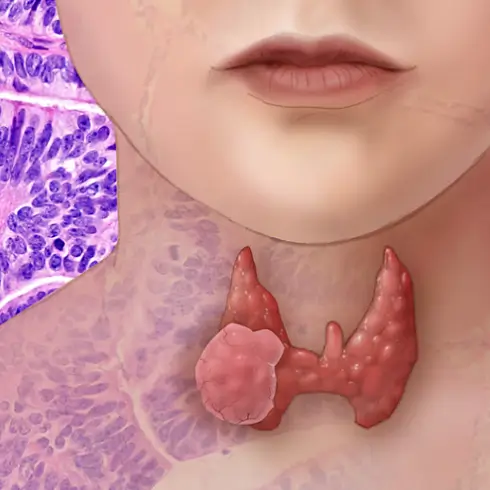 갑상선암 수술 흉터 정도