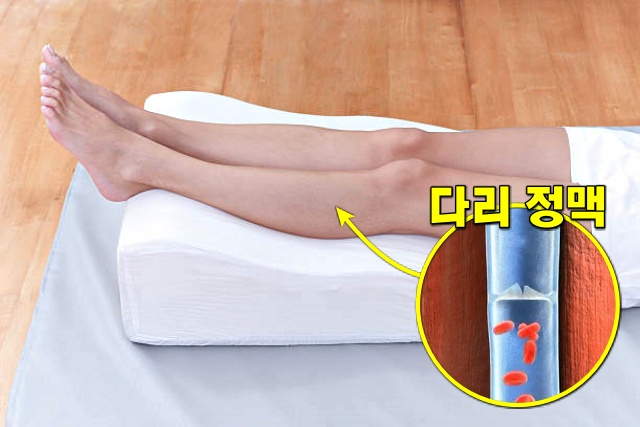 하지정맥류 증상 예방 무릎 베개 수면 자세 다리 붓기 발시림 혈액순환, 건강 팁줌 매일꿀정보
