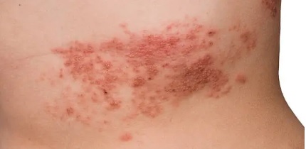 대상포진