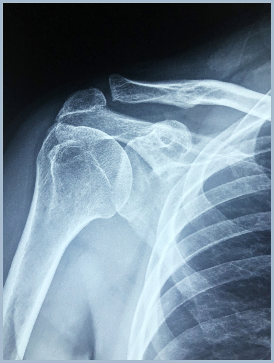 회전근개파열이란? 팔을 들어올리기 힘들다면!