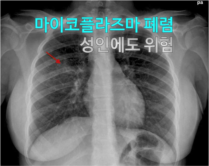 마이코플라즈마 폐렴 성인에도 위험