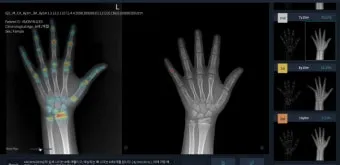 성장판 닫혀도 키 클 수 있는 방법과 성장 호르몬 시기_22