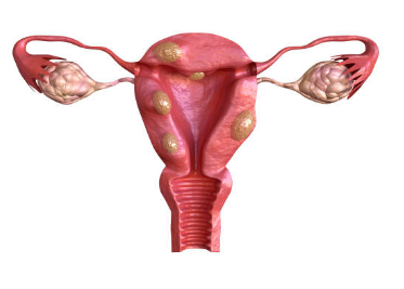 자궁근종 증상, 수술후 회복기간, 크기별 치료 총정리 (2024ver)