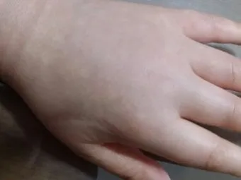 손등 붓는 이유 혈액순환 문제 증상과 해결법 정리_3