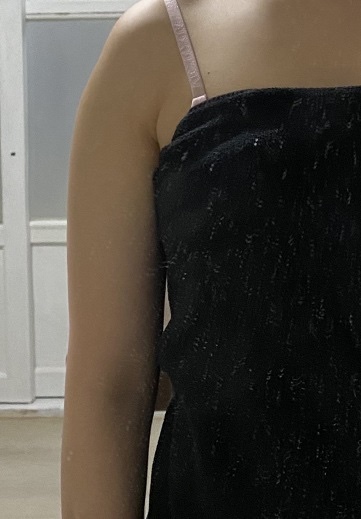 팔뚝 지방분해 주사 후기