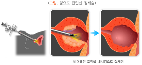경요도전립선절제술