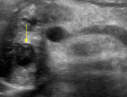 Ampulla Vater Cancer