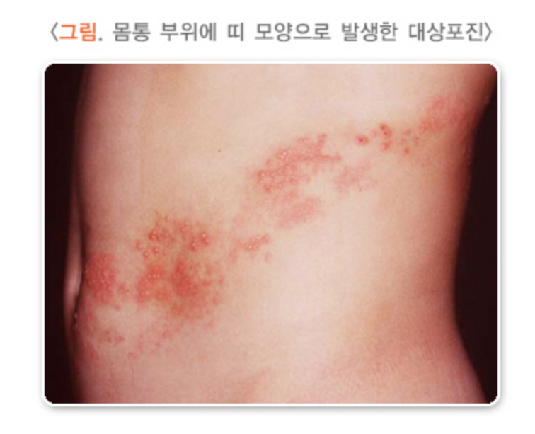대상포진