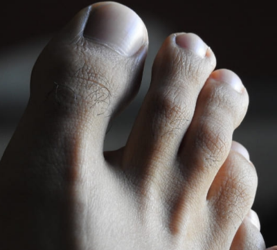 발톱 검은색 세로줄, 단순 멍일까? 흑색종일까?