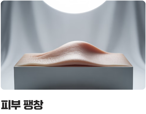 튼살, 도대체 왜 생기는 걸까?