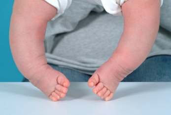 선천성 만곡족 (Congenital Clubfoot)