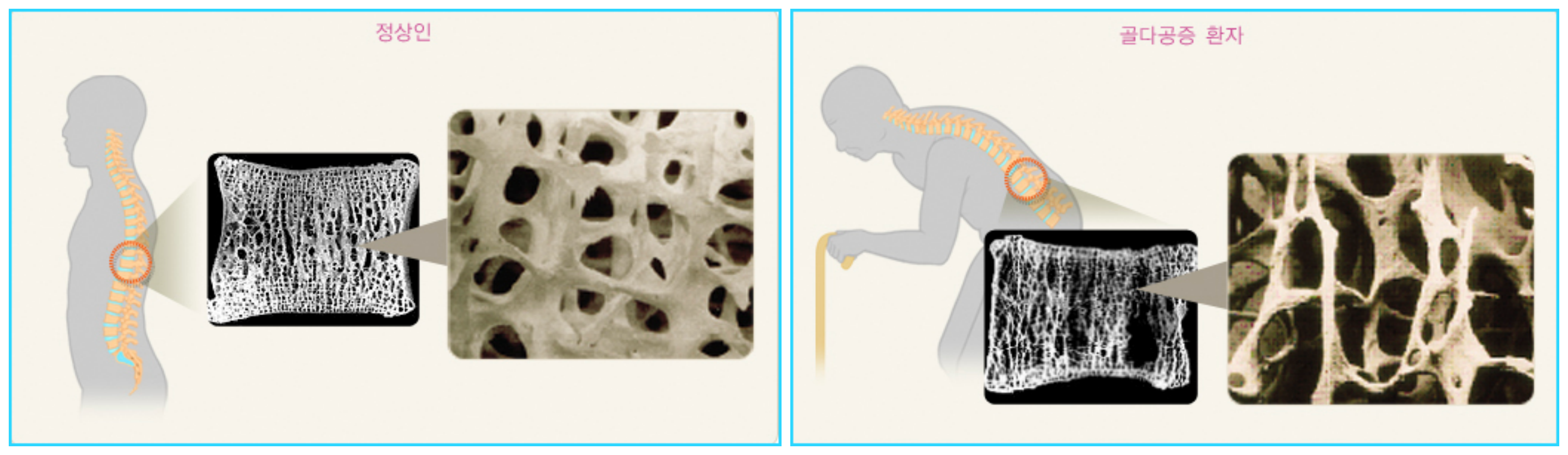 정상인과 골다공증 환자
