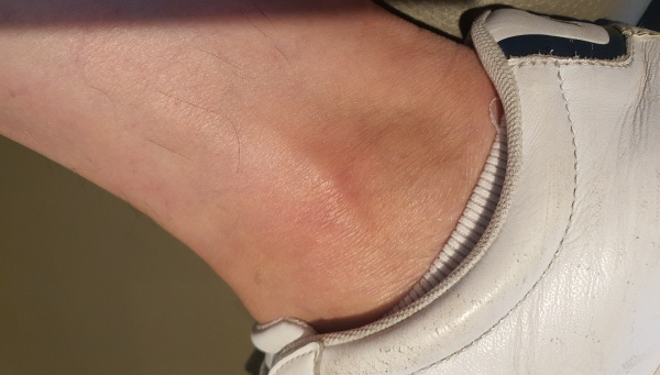 통증이-발생된-발목