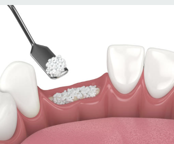 잇몸 뼈 이식