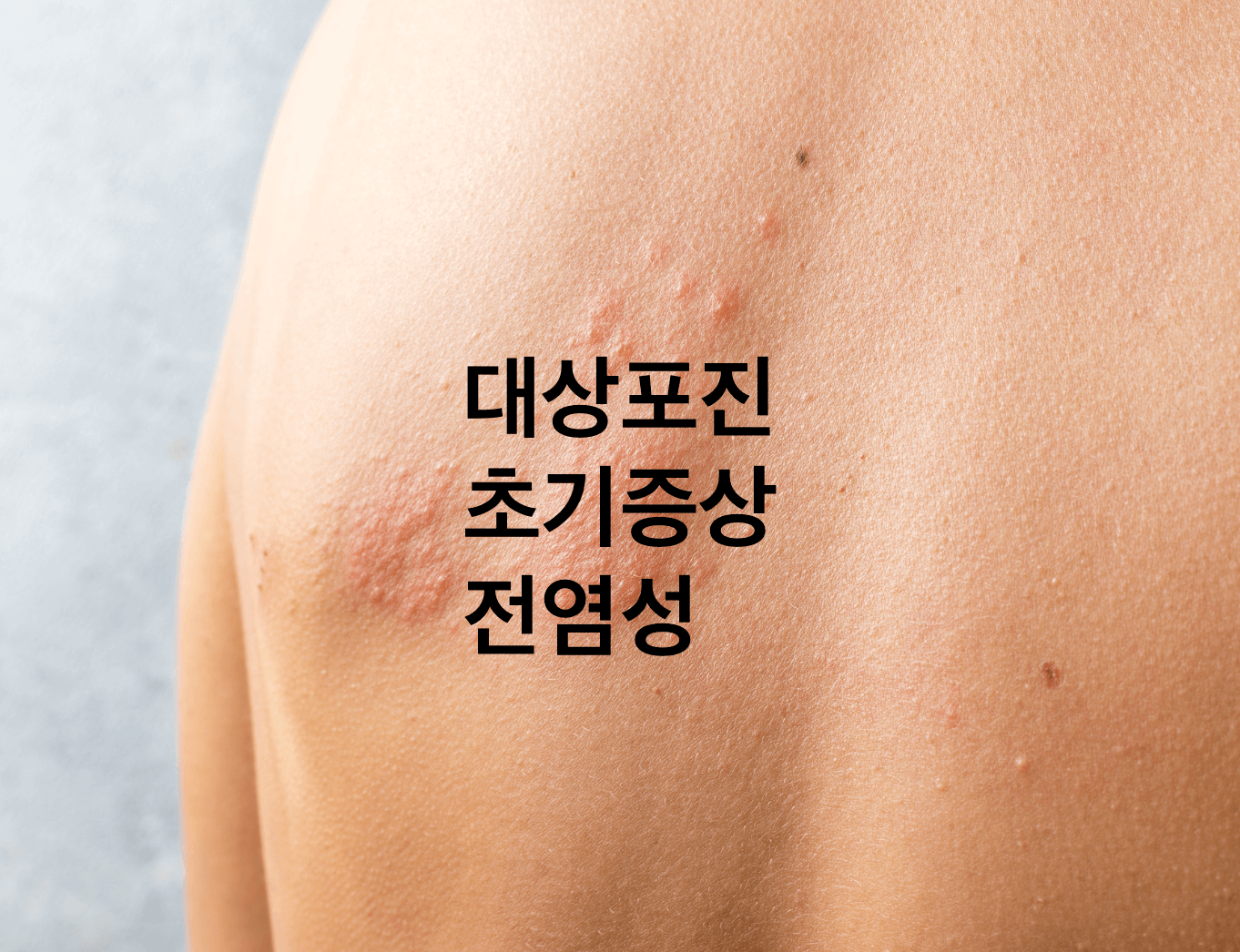 대상포진