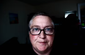 검버섯 없애는 방법 민간요법 얼굴 손등