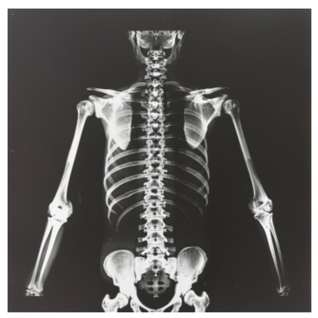 골다공증과 관련된 사진입니다.