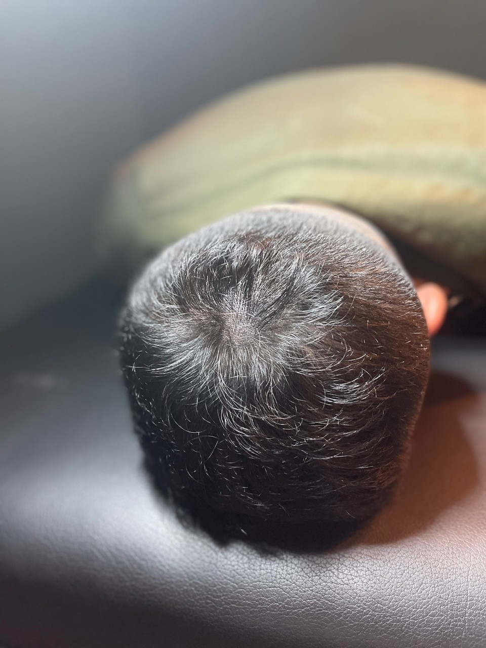 SMP 두피문신 가격문의