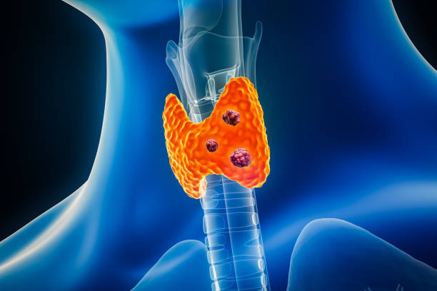 갑상선 유두암 갑상선암 증상 치료 미세유두암 수술 예후 재발 동위원소 방사선 요오드 전이 단계 1기 후 원인 분화암 음식 이란 에 좋은 주의할 점 임파선 림프절 크기 별 완치율 유두상암 림프