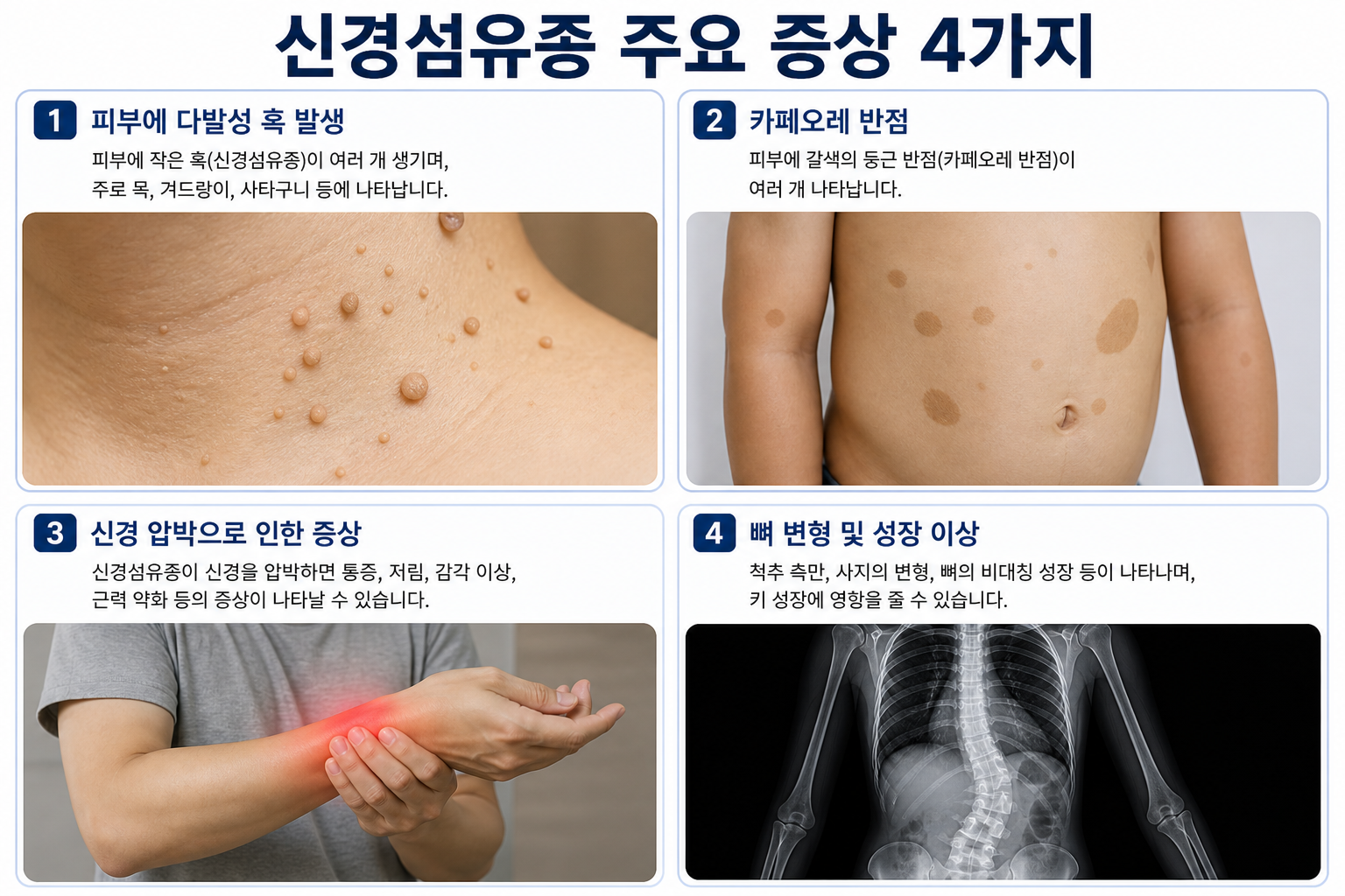 신경섬유종 증상.원인.치료