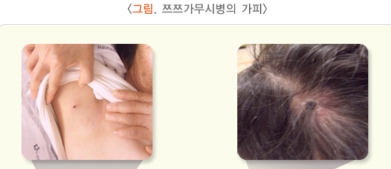 쯔쯔가무시병의 딱지