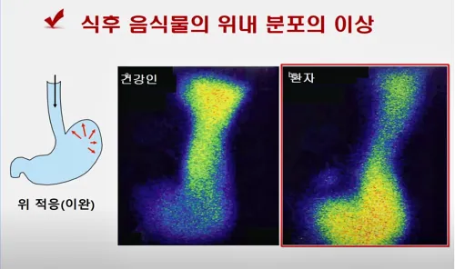 식후 음식물의 위내 분포된 모습