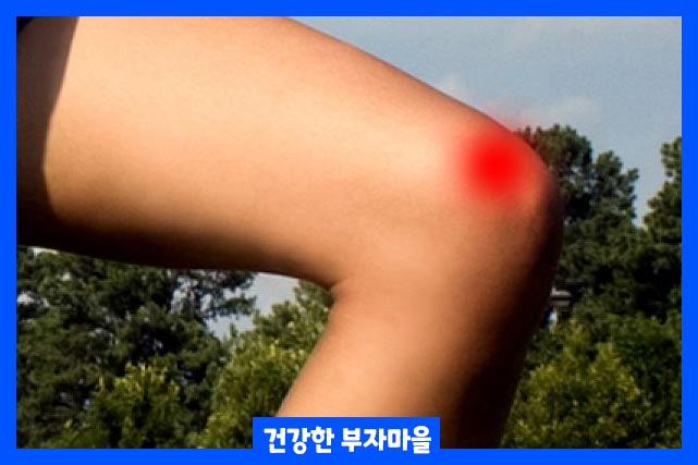 노화로 인해 자연적으로 발생합니다. 그런데 뼈 사이의 관절 연골이 손상되거나 부서지면 퇴행성 관절염이 발생
