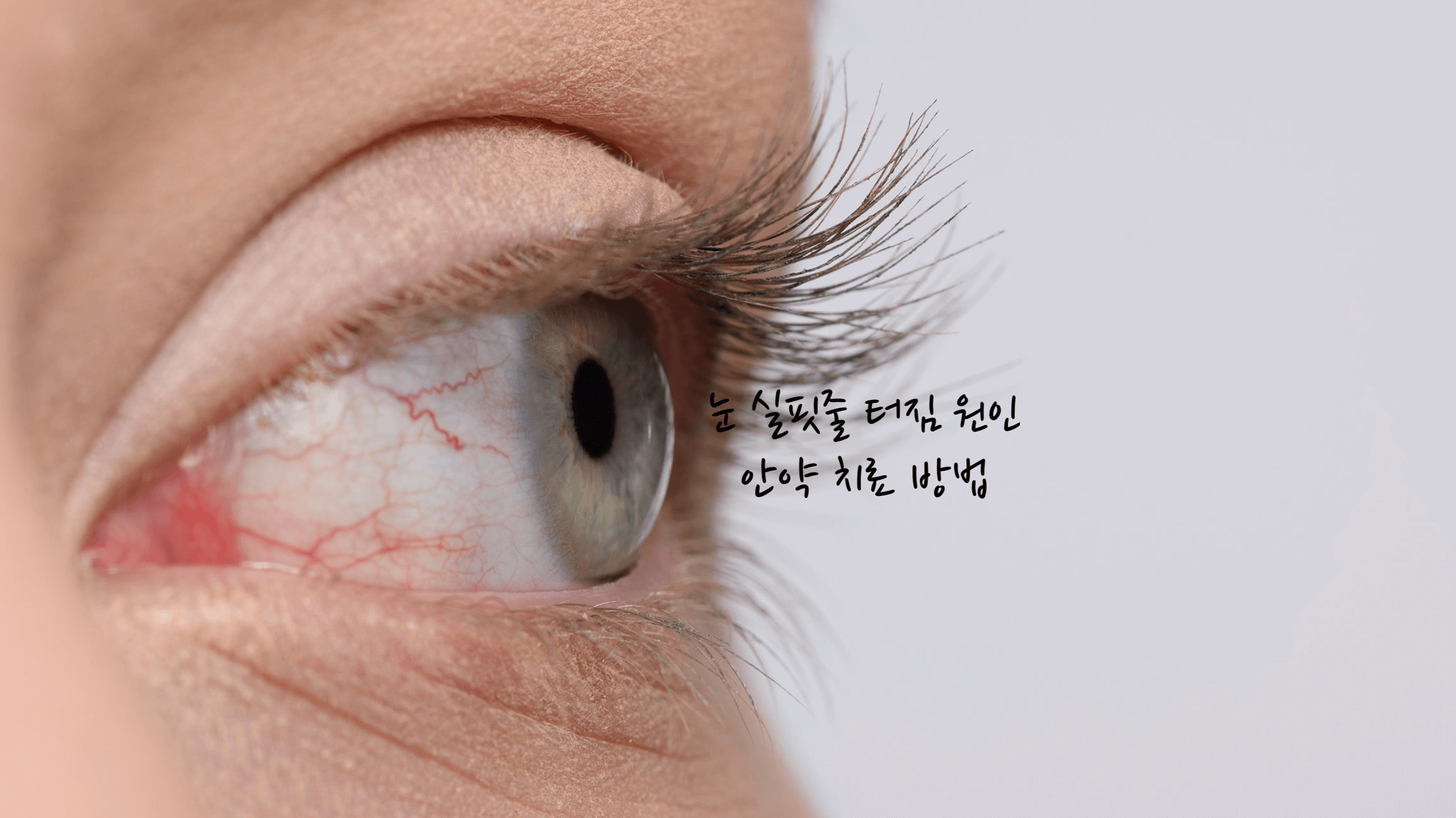 눈 실핏줄 터짐